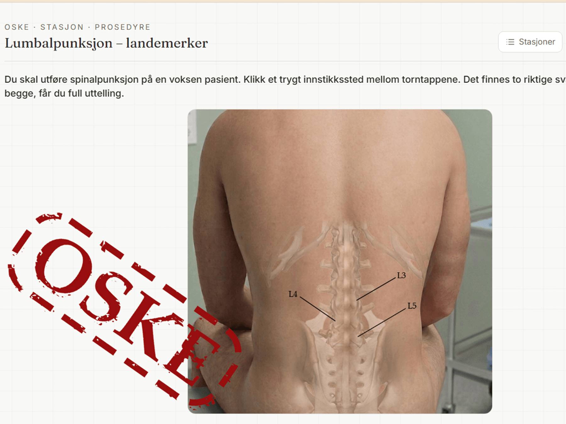 En stasjon i lumbalpunksjon: et fotografi av en rygg med skjelettet lagt over og virvlene L3, L4 og L5 merket.